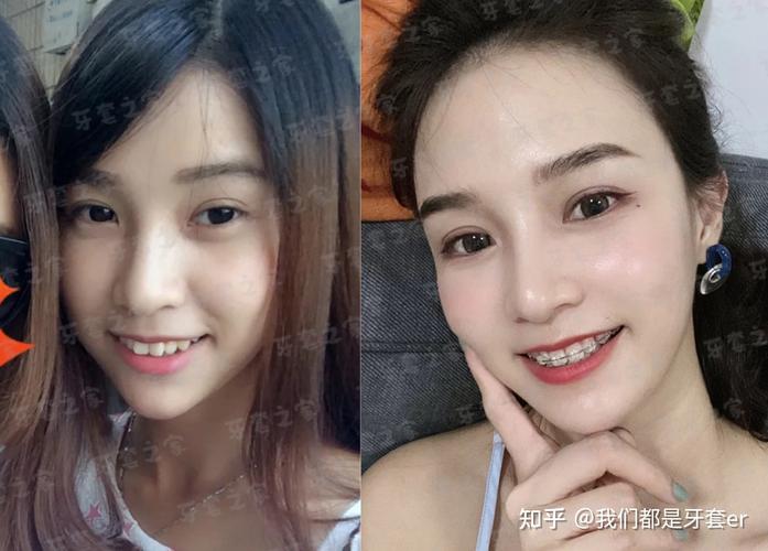 上海43岁矫正深覆合牙齿要多少钱?从检查到摘牙套费用全掰扯清楚