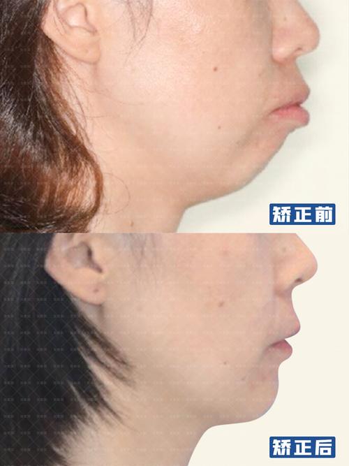 上海矫正牙齿能改善下巴后缩吗?3个关键问题正畸医生一次说清