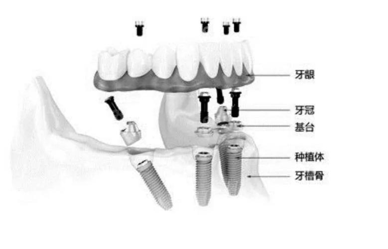 上海半口种牙费用不固定 一颗大概多少钱