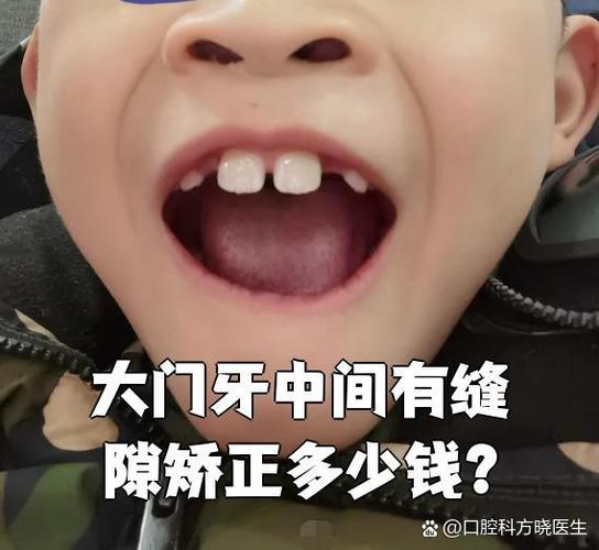 上海保定矫正牙齿费用一览:一般多少钱?价格明细来了
