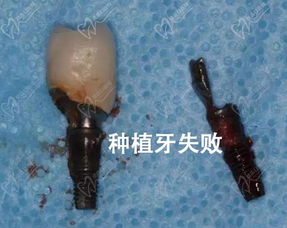 上海深圳福田单颗种植牙哪家医院靠谱?看这里就对了!