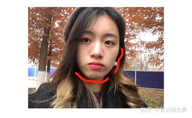 上海莲塘小孩正畸多少钱?费用明细和避坑指南