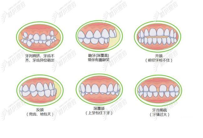 上海南阳牙齿矫正多少钱?2026最新价格大公开