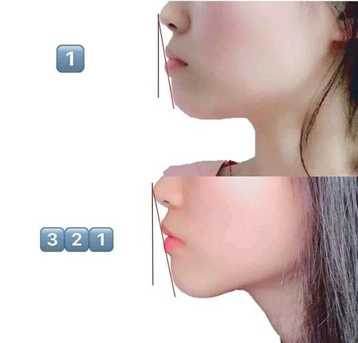 上海34岁做龅牙矫正还来得及吗?我的真实感受