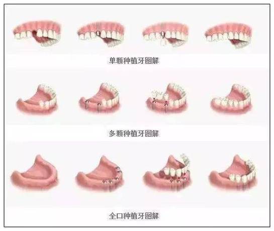 上海半口种植牙全过程要多久？疼不疼？一步步讲清楚