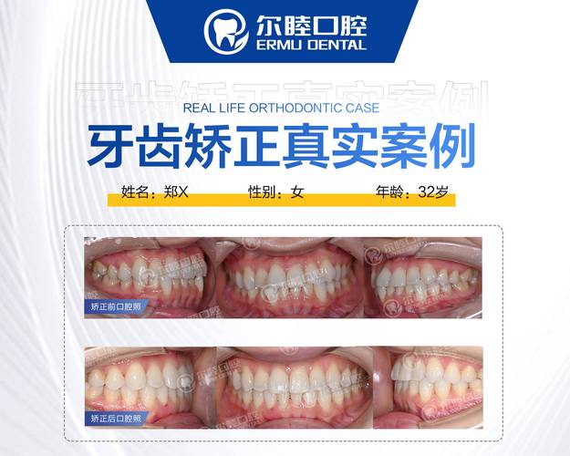 上海成人矫正牙齿咬合疼不疼？效果和费用全解析