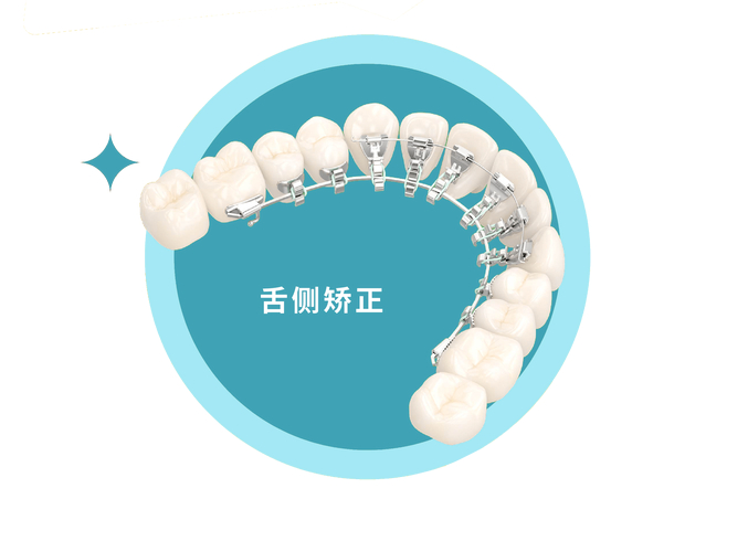 上海成年人牙齿舌侧正畸到底值不值？看完这几点就懂了