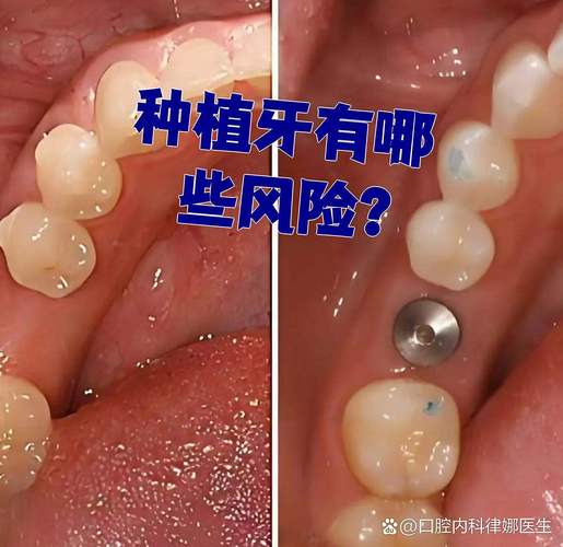 上海全口种植牙的风险和后遗症有哪些