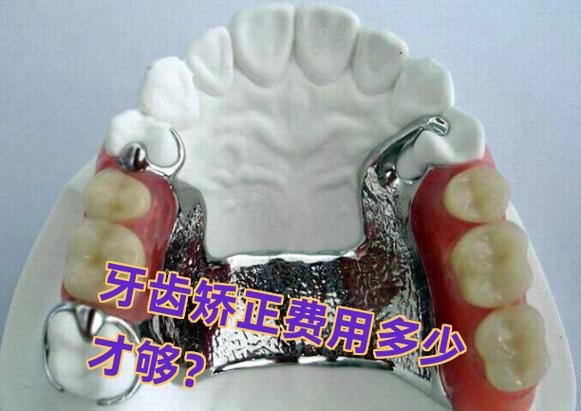 上海长沙矫正牙齿费用一览：从几千到几万差在哪