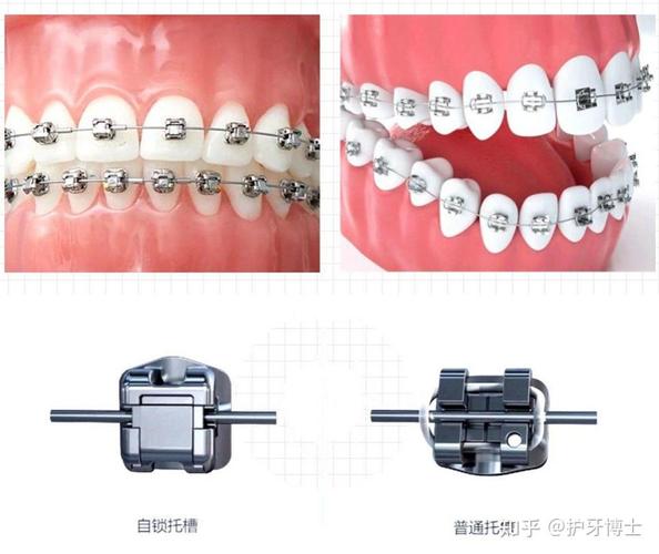 上海暴门牙矫正费用一览