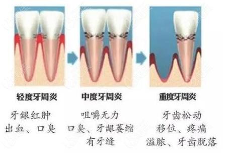 上海深圳牙周炎治疗到底要花多少钱？2026最新费用解析