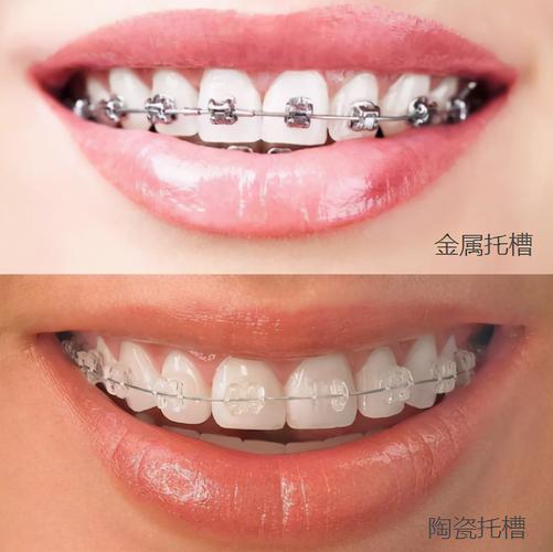 上海深圳深覆合矫正费用大揭秘：到底多少钱才靠谱？