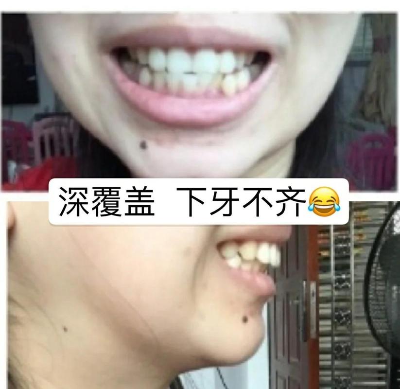 上海39岁牙齿矫正还有用吗 真实效果看这里