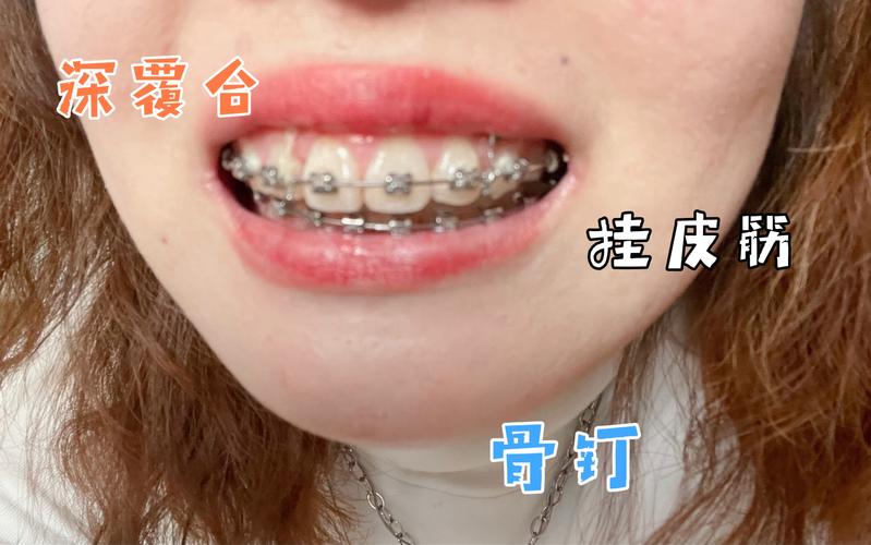 上海深圳深覆合正畸去哪家好?牙科推荐避坑指南